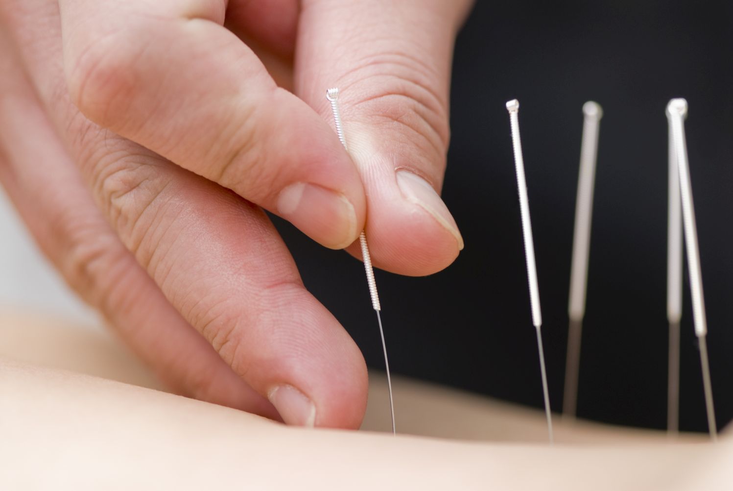 Avanti Acupuncture
